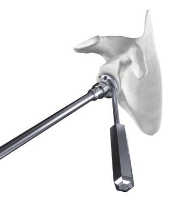To limit any risk of impingment, it is important to properly align the inferior edge of the drill guide with the inferior edge of the glenoid.