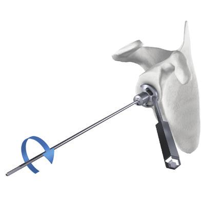 b) Guide Pin Positioning Place the 2.5 mm drill guide into the glenoid surface making sure that its bottom surface is perfectly seated on the bone.