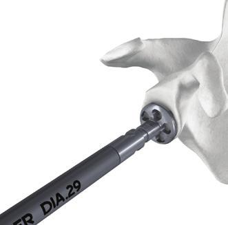It is recommended to start the reamer before contacting the glenoid surface and ream until the glenoid surface is flat.