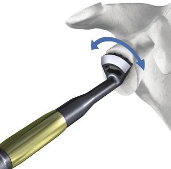 d) Peripheral Reaming To obtain good fixation of the glenoid sphere on the baseplate, peripheral reaming is necessary.