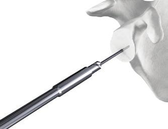 Diam. peripheral reamers must be used with 33 mm spheres during glenoid preparation.» 42 mm Diam. peripheral reamers must be used with 39 mm spheres during glenoid preparation.
