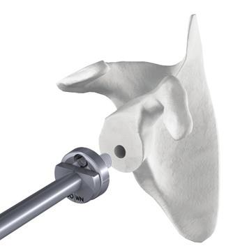 POSITIONING OF THE GLENOID BASEPLATE The glenoid baseplate is attached to the baseplate impactor through its central hole using a screw in the impactor central shaft.