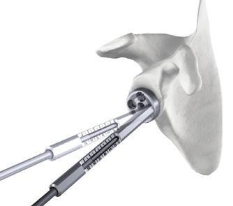 Anterior and Posterior Screw Fixation The anterior and posterior screws are positioned first to optimize compression of the baseplate.