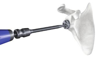 Using the ø 3 mm drill bit, drill the screw hole through the compression screw drill guide for anterior-posterior compression screws.