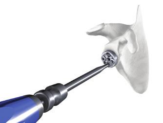 The inferior screw is positioned into the pillar of the scapula. The inferior screw can be oriented within a range of 30 inferiorly and +/- 15 in the transverse plane.