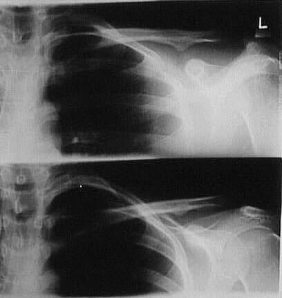 Respiration CLAVICLE PA AXIAL