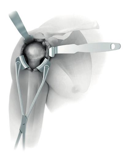 Reversed Humeral Exposure Delto-Pectoral Approach An incision is made from the tip of the coracoid along the delto-pectoral roove, slightly lateral to the axillary fold.