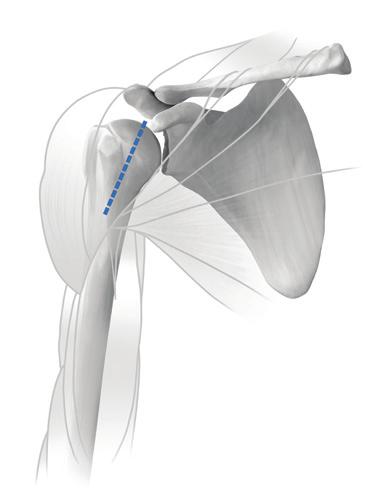 A Hohmann retractor is positioned behind the coracoid. Care should be taken to preserve the origin and insertion of the deltoid.