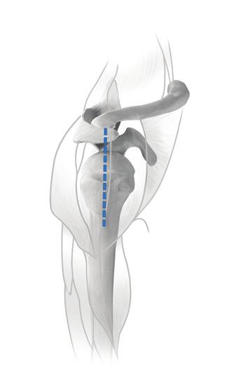 Supero-Lateral Approach The incision is made from the acromioclavicular joint along the anterior border of the acromion and downward approximately 4 cm. The deltoid is split in line with its fibers.