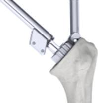 Proximal Preparation Metaphyseal Punch Two options are available to guide the Punches which have been designed to score the proximal metaphyseal cancellous bone.