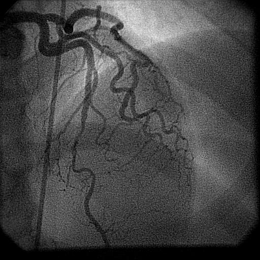 Cardiac Catheterization Coronary angiogram showed a long, diffuse 75% lesion in