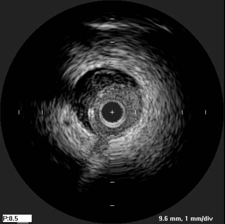IVUS revealed the presence of spontaneous coronary artery dissection (SCAD)