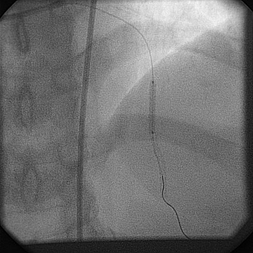 Cardiac Catheterization A sirolimus eluting stents (Cypher RX), 2.