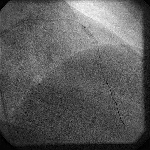 Following second stent deployment dissection propagated proximally (arrow