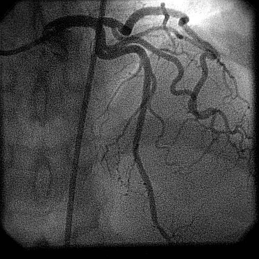 Post Procedure Final angiographic appearance demonstrated complete dissection coverage and excellent flow in the LAD territory (Figure 6).