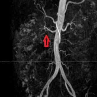 Magnetic resonance angiography (MRA) of the right renal artery had a beaded appearance, most consistent