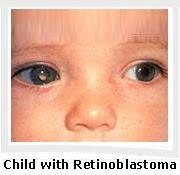 the disease Sporadic retinoblastoma Mutations of both copies of RB1