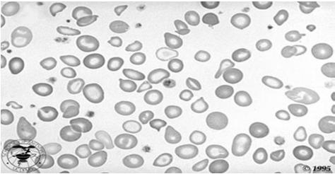 RBC Morphology Iron Deficiency Anemia RBC Morphology Associated With Hemolysis Spherocytes: spherical