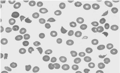 RBC Morphology Schistocytes: fragmented cells (DIC, MAHA, TTP, HUS, cardiac valves, etc) Howell-Jolly body: