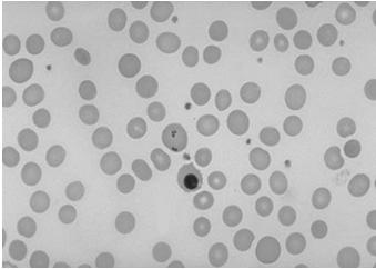 mycoplasma, mono) Schistocytes Peter Maslak, ASH Image Bank 2013; 2013-3718 Copyright 2013 American Society