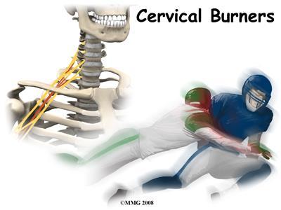 Injury to the nerves of the neck and shoulder that cause a burning or stinging feeling are called burners or stingers. Another name for this type of nerve injury is brachial plexus injury.
