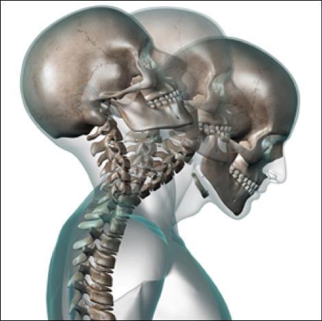 Neurogenic TOS Etiology Hyperextension neck injury (whiplash)