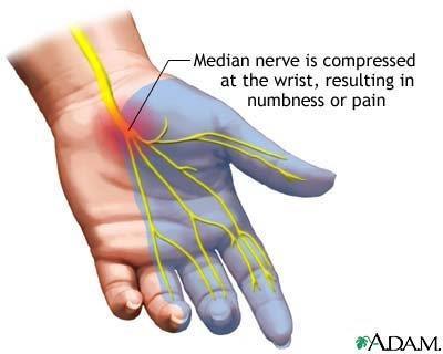 where the median nerve gets compressed at the wrists The