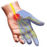 Carpal Tunnel Syndrome Hand Paresthesias Median nerve