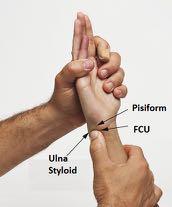 TFCC Injuries Ulnar wrist pain + / - clicking Point