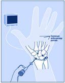 TFCC Injuries Surgery Indications : Acute instability DRUJ Fracture of