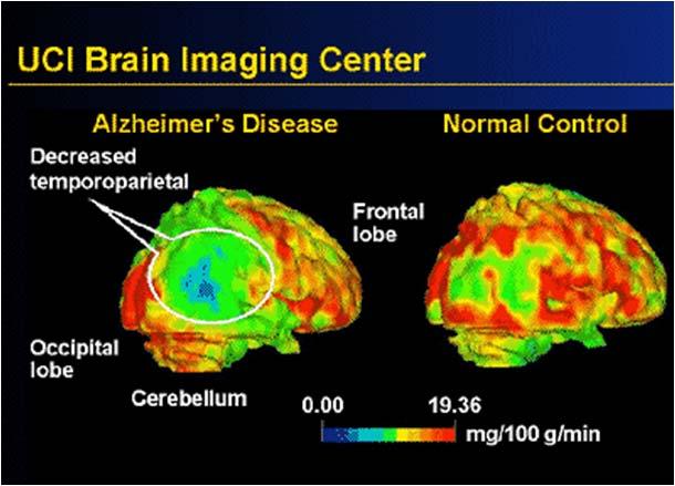 29 Functional Imaging PET scanning with fluorodeoxyglucose (FDG PET) indicates that AD is associated with reduced glucose uptake in brain areas important for memory, learning and