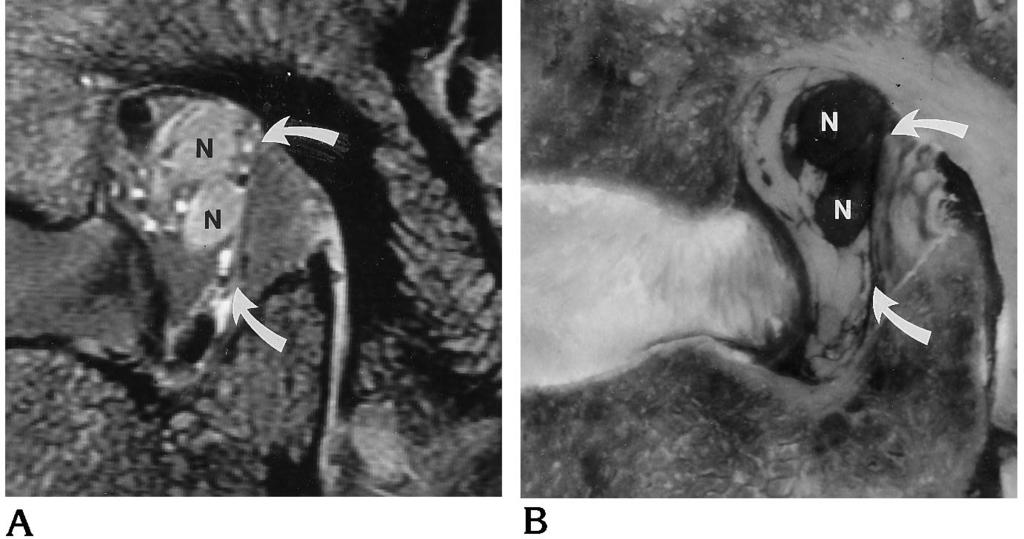 Fig 4. Illustration of occult stenosis with nerve root compression in the neural foramen at the L5-S1 level associated with a posterior radial tear in the intervertebral disk.