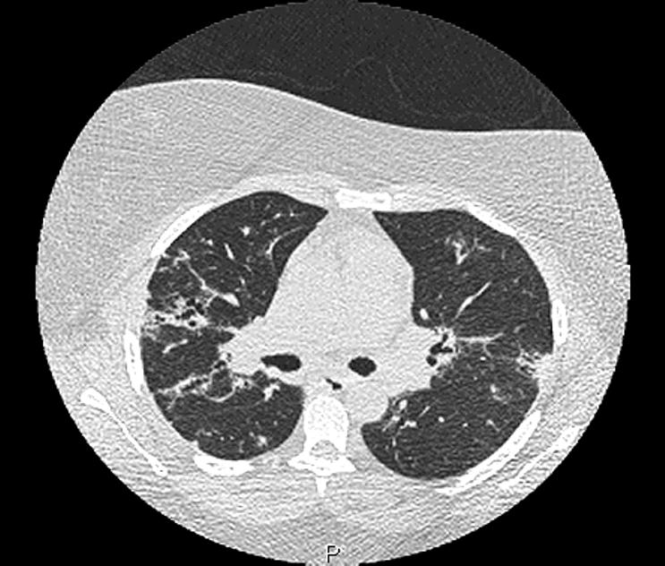 A 48-year-old obese (BMI >40), hypertensive lady with known sarcoidosis is seen in clinic with a minor deterioration in lung function and raised serum ACE.