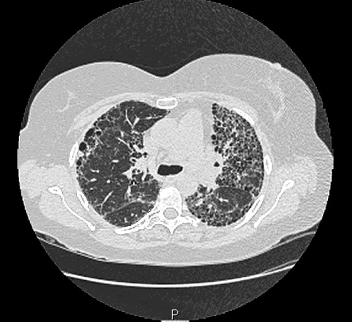 A 57-year-old female smoker presents with a six-month history of cough and increasing dyspnoea. Chest radiograph is abnormal and HRCT is performed.