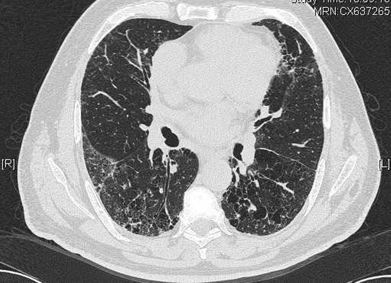 A 72-year-old man is referred with a ten year history of mild exertional dyspnoea. He has a strong family history of pulmonary fibrosis.
