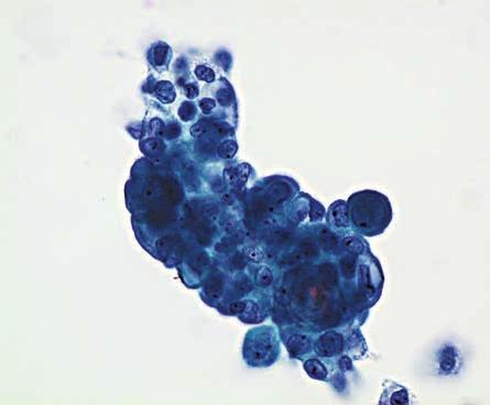 Arun 603 Usually, ductal lavage specimens are divided into several cytologic categories benign cells, atypical cells, malignant cells, and ICMD.