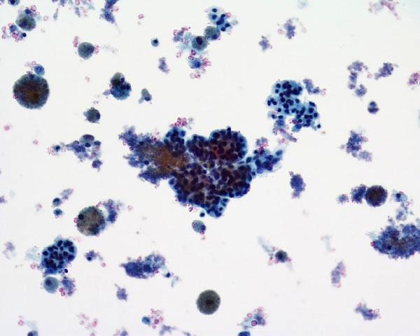 FirstCyte Ductal Lavage History: 68 Year Old Female Gail Index: Unknown Clinical History: Negative Mammogram in 1995 6 yrs.