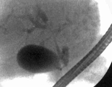 Singapore Med J 2010, 51(9) 745 S.. Fig. 2 ERCP image shows hilar stricture with resultant dilated intrahepatic dust in a man with nonspecific symptoms of TB infection and obstructive jaundice.