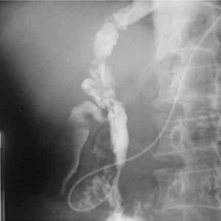 The patient was managed with anti -TB treatment and prolonged stenting. that are common to all TB infections and other conditions, such as fever, weight loss and anorexia, are also common.