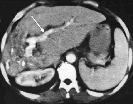 Singapore Med J 2010, 51(9) 748 I2a 0 Fig.!! CT image shows hepatic calcifications in the atrophic right lobe and ductal dilatation (arrow).