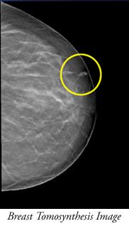 chemotherapy Mammogram