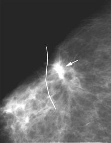Mammography Post Mastectomy Radical mastectomy, no annual