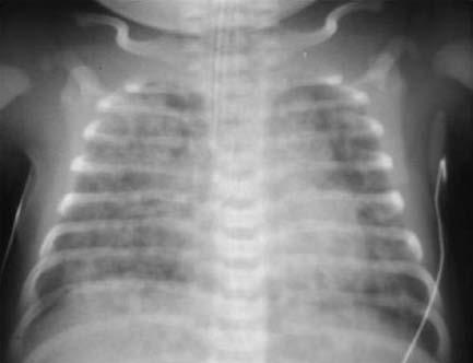 CT: CXR indicative of? Meconium Aspiration Pneumonitis RN/RCP: Asses pt, breath sounds, patent and secure airway, vital signs MD: Order for mechanical ventilation CMV: TCPL: Rate 60 IT.