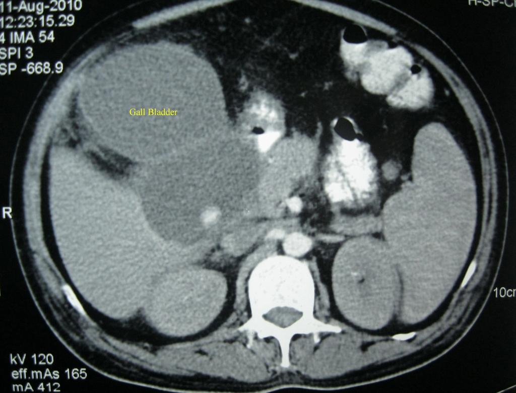 Figure 1: Axial section of CECT of abdomen showing a distended gall