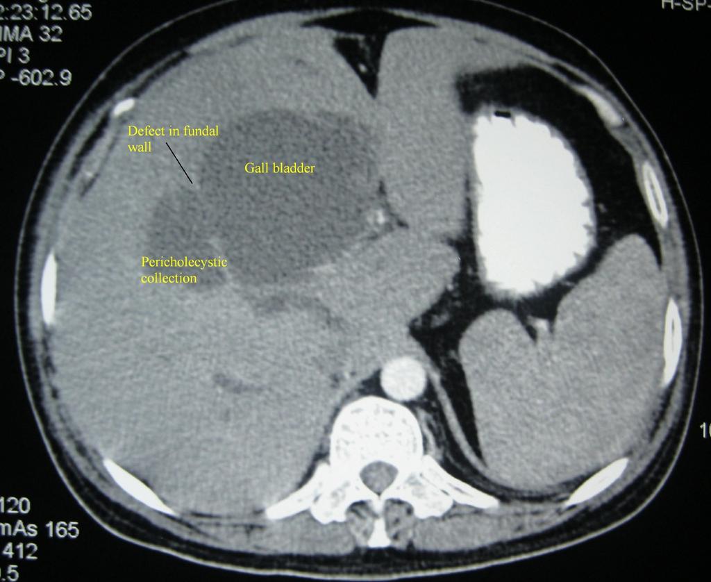 fundus of gall bladder with a communication with a pericholecystic