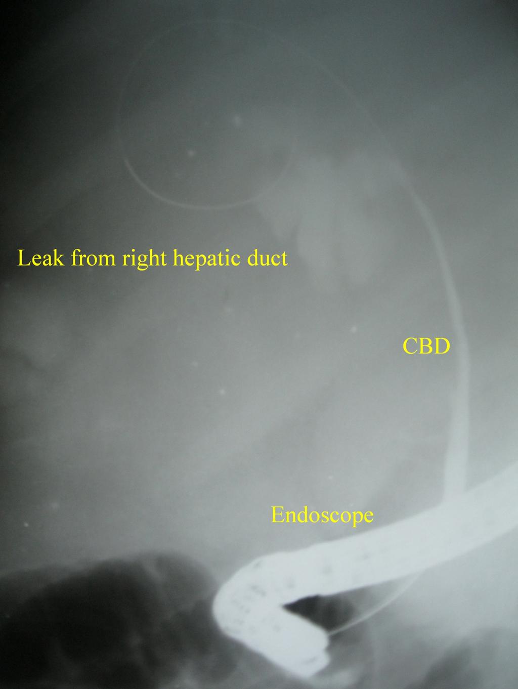Figure 3: ERCP image showing a compressed CBD in its