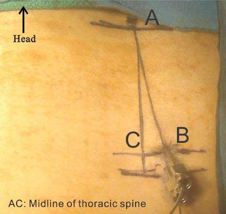 Alternative Approach to Needle Placement in Spinal Cord Stimulator Trial/Implantation Fig. 2. The lines drawing at the skin for needle placement of the spinal cord stimulator. A point.