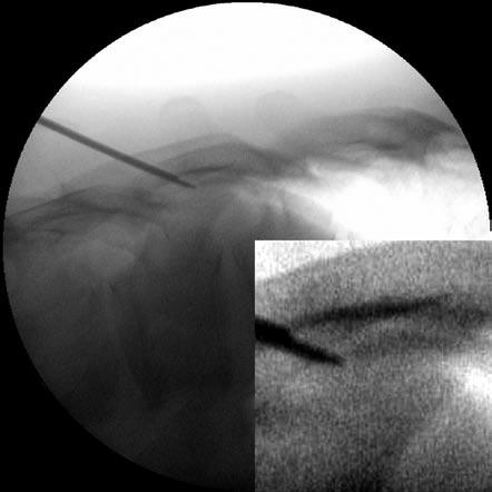 Alternative Approach to Needle Placement in Spinal Cord Stimulator Trial/Implantation Fig. 7. The needle reaches the S point (the base of the target Z-joint line) under fluoroscopic guidance. Fig. 8.