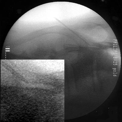 Alternative Approach to Needle Placement in Spinal Cord Stimulator Trial/Implantation Discussion The LOR technique is a reliable method for localizing the epidural space in most clinical situations.