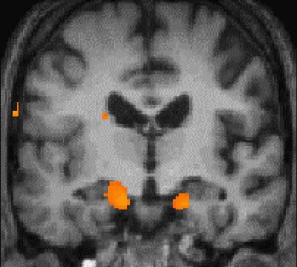 494 L. Cipolotti et al. / Neuropsychologia 44 (2006) 489 506 normalized image smoothing each grey matter segment with an 8 mm FWHM smoothing kernel.